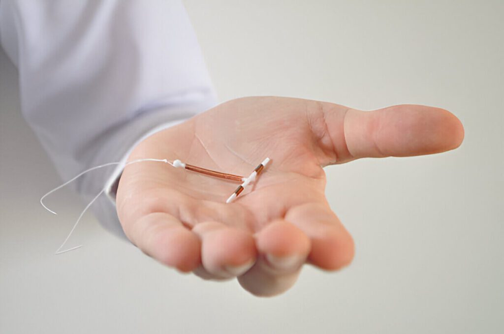 IUD Removal What to Expect